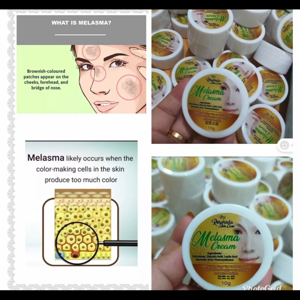 Melasma Remover Cream Freckle Dark Spot Sun Damage